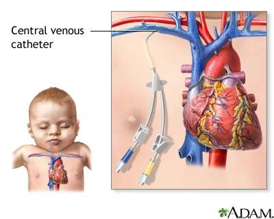 Central venous catheters - ports: MedlinePlus Medical Encyclopedia