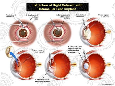 Types Of Cataract Surgery / Cataract Surgery Specialists in Portland | Cataract ... / We also ...