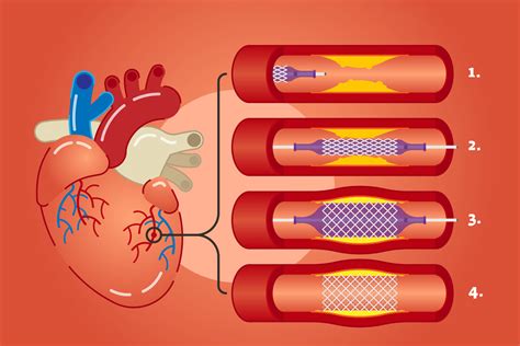 Coronary Angioplasty | Dr. Benny Jose