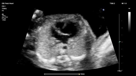 fetal echo tricuspid atresia, small RV – SujyotHeartClinic