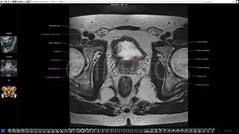 Prostate Anatomy Pelvis