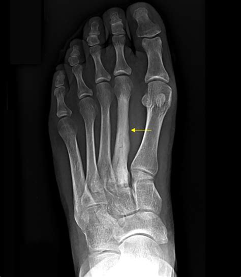 Metatarsal Stress Fracture Mri