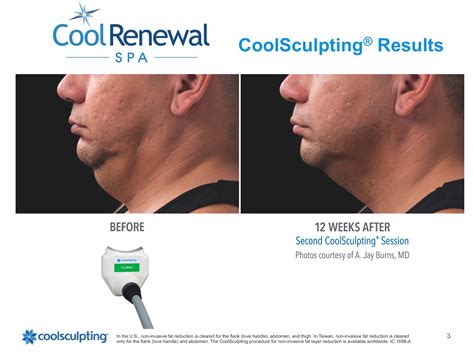 Before & After | Cool Renewal Med Spa