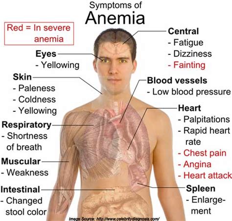 Is there a Link Between Iron Deficiency Anemia and Osteoarthritis?