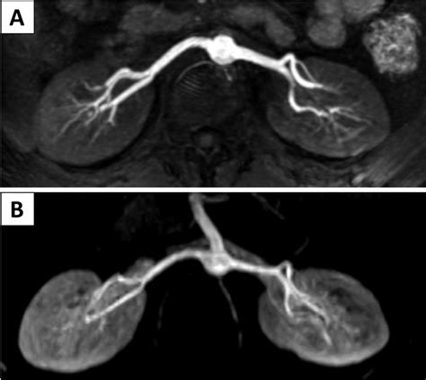 A case of 23 years old male with suspected renal artery stenosis: MIP ...