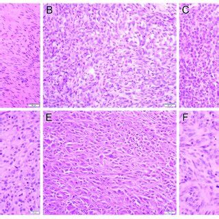 Examples of gastrointestinal stromal tumor histology include sclerosing ...