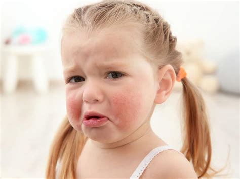 Food Allergies In Kids: Symptoms, Testing, Tips and Advice