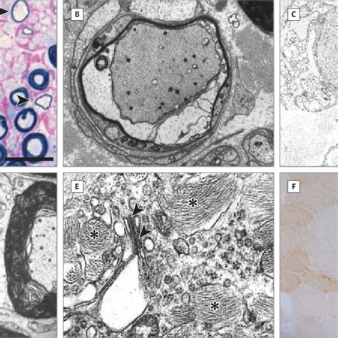 Results of Sural Nerve Biopsy, Electron Microscopy, and Muscle Biopsy | Download Scientific Diagram