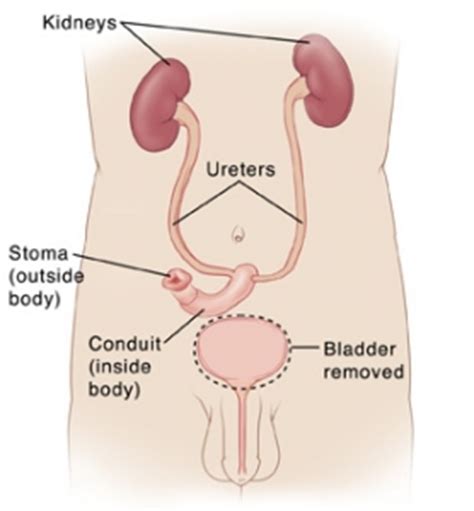 Types of Surgery - Ostomy Care & Supply