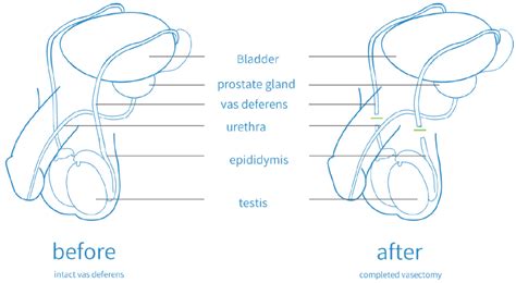 Vasectomy - Preston Family Medical