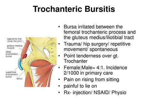 Trochanteric Bursitis