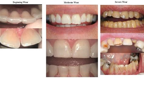 Bite Splints & Mouthguards | Michael S. Singleton D.D.S