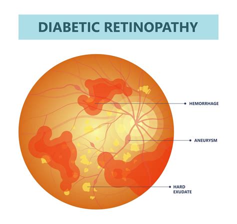 Understanding The Correlation of Glaucoma Caused by Diabetes