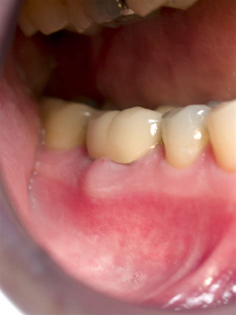 gingival abscess | Read about it in books, heard about it on… | Flickr