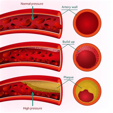 High Blood Pressure and Vascular Disease — Vascular Cures