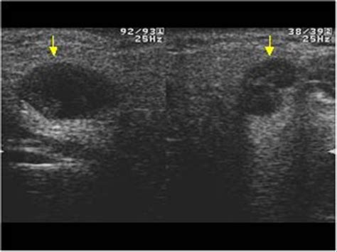 Head and Neck | 4.3 Salivary glands : Case 4.3.4 Warthin's tumors | Ultrasound Cases