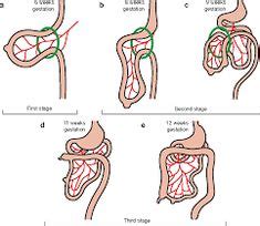 Illustration of Malrotation with Ladd's bands | Pediatric radiology ...