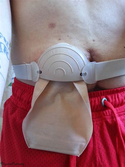 Ostomy Accessories Guide: Stoma Guards | VeganOstomy