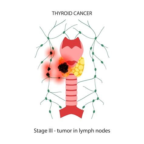 Premium Vector | Thyroid cancer stages