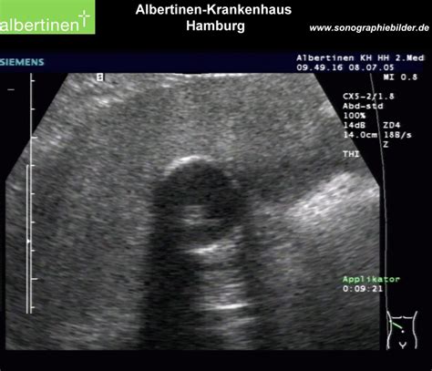 Sonography of the gall bladder (porcelain gallbladder) - DocCheck