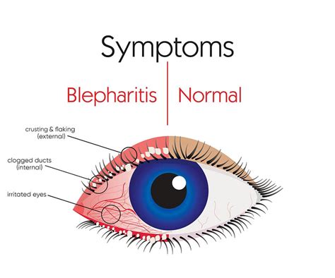 Zephyrhills Blepharitis Treatment Clinic - Florida Eye Center