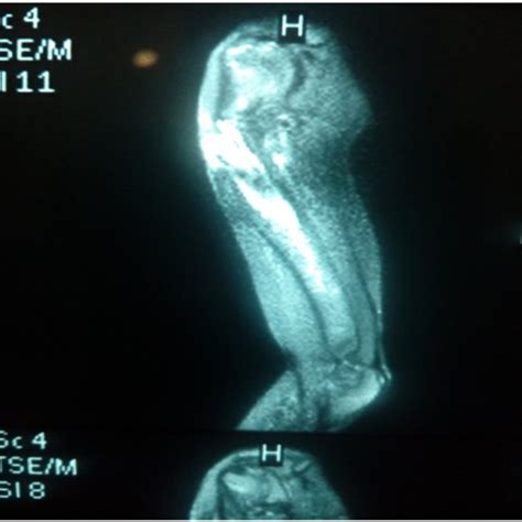 MRI show abnormal expansion, cortical thickening and diffuse altered... | Download Scientific ...