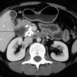 CT showing atrophic pancreas with a dilated (1 cm) pancreatic duct (a ...