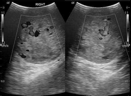 Testicular Choriocarcinoma Ultrasound