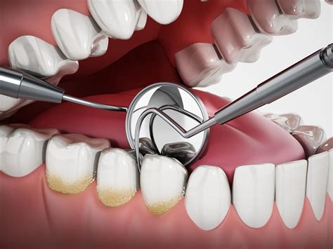 Plaque on Teeth (Causes, Treatment, & Prevention)