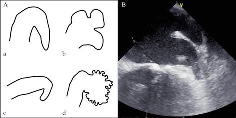 Percutaneous Left Atrial Appendage Closure