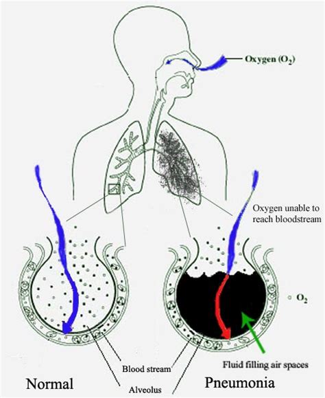 Ventilator Associated Pneumonia Pathophysiology