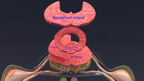 Spinal cord lesions and clinical signs and symptoms 3D model - Blender Market