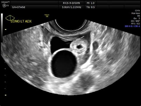 Ovarian Cyst And Pregnancy Ultrasound