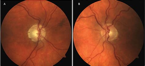 grosor Crueldad Productividad optic nerve head glaucoma construir orar ...