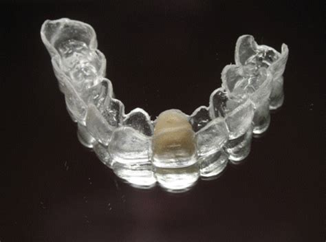 Clear Essix Pontic Retainer – Digital Dental Prosthetics