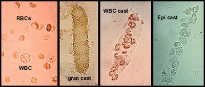 some casts found in urine | Medical Laboratories