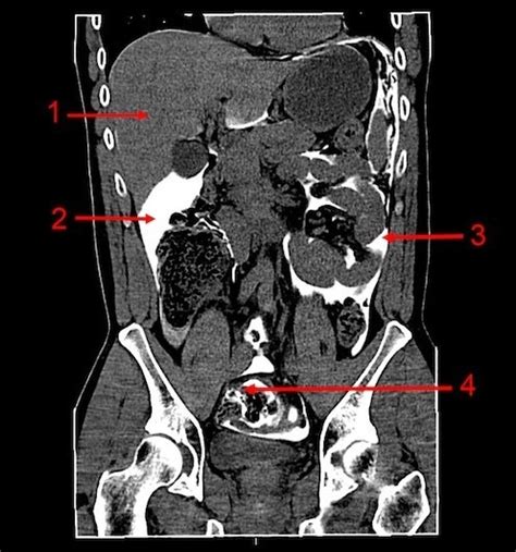 CT abdomen (coronal) with rectal contrast:1. Liver, 2. | Open-i