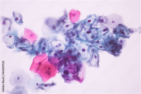 View in microscopic of koilocyte cell criteria of HPV (Human Papilloma virus) infection.Pap ...