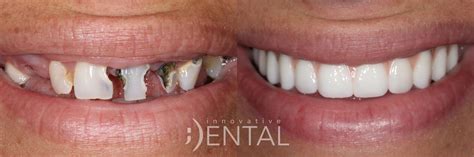 Implant-Supported Dentures Springfield Missouri MO.