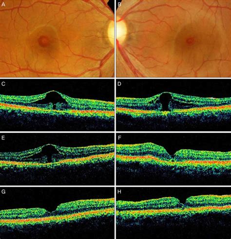 Macular hole causes, symptoms, diagnosis, treatment & prognosis