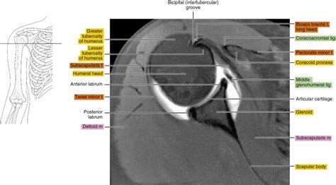 MR arthrography of the shoulder | Radiology Key