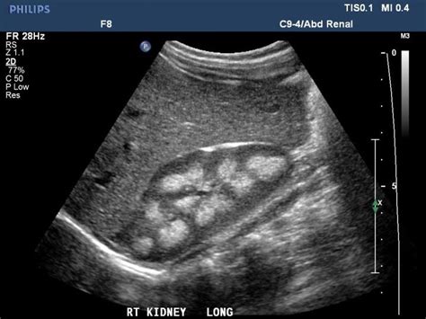 Medullary Nephrocalcinosis | Medical ultrasound, Ultrasound, Radiology