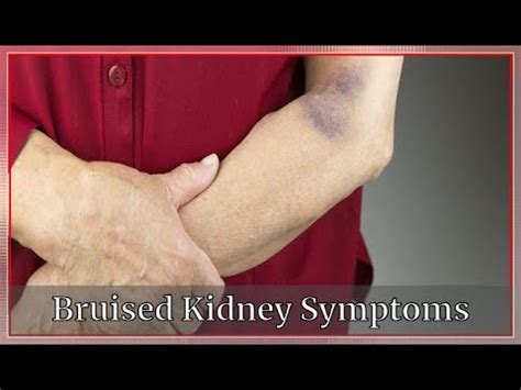 Bruised Kidney Symptoms | Very Well - YouTube