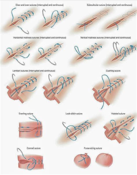 Different types of Surgical suturing techniques. - MEDizzy