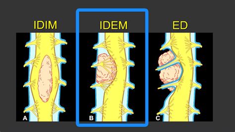 Mri Mastery Series Intradural Extramedullary Spinal Lesions Mri Online ...