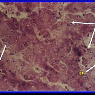 Stages of hepatocytes degeneration: karyorrhexis (K), karyolysis (KL)... | Download Scientific ...