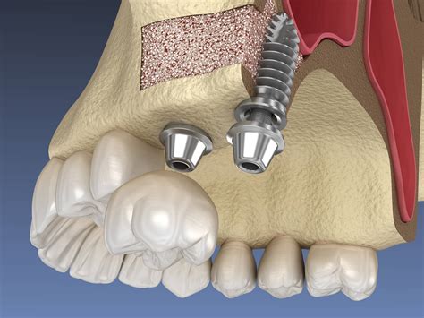 Sinus Augmentation – Oral & Facial Surgery Group