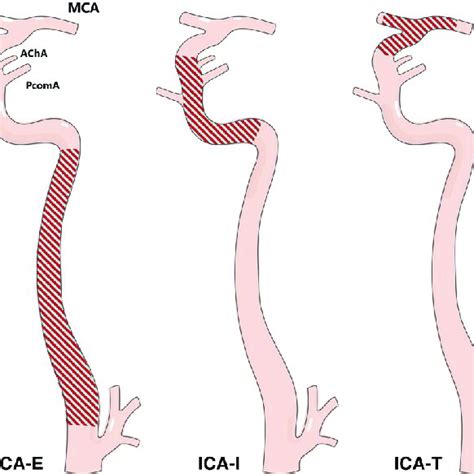 Occlusion patterns of the internal carotid artery. ACA, anterior... | Download Scientific Diagram