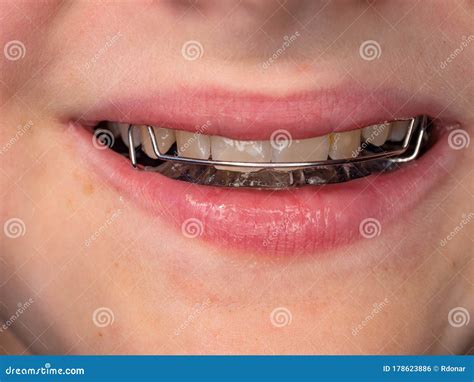 Smile Teenage Boy Wearing Orthodontic Braces Stock Photo - Image of ...