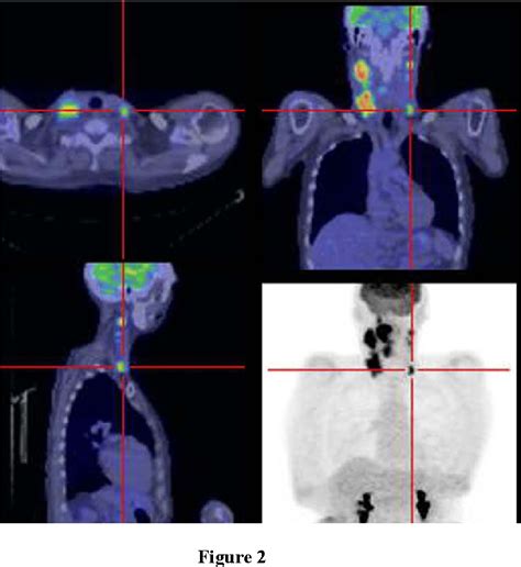 [PDF] Use of PET and PET/CT for radiation therapy planning: IAEA expert report 2006-2007 ...